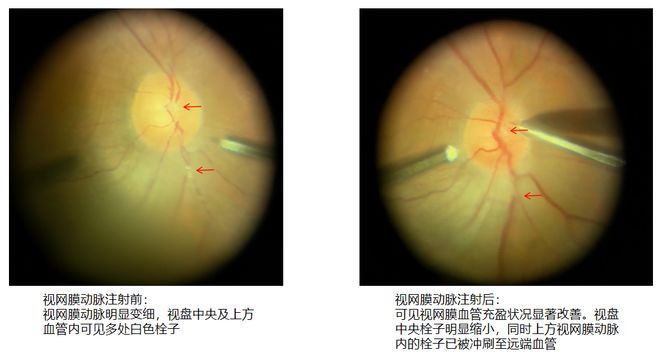 浙江70岁男子坐公交司机一个动作他眼睛就看不见了！医生：细胞不可逆死亡(图1)