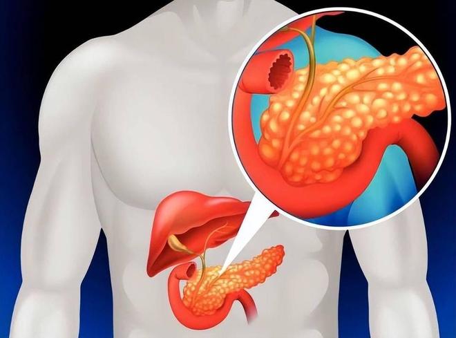 医生提醒：吃饭后一旦出现5个表现十有八九是胰腺炎尽早检查(图13)