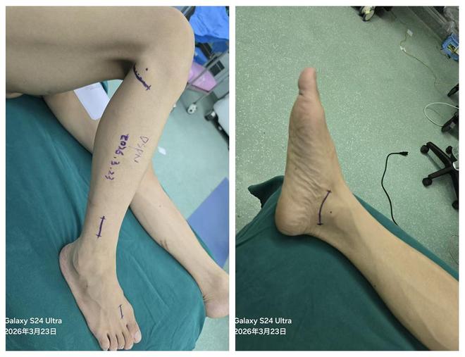 糖尿病下肢疼痛束手无策？常德一医这项微创手术让患者摆脱止痛药(图1)